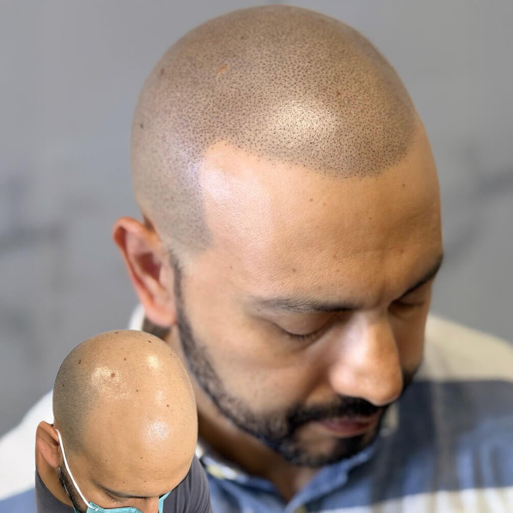 10depoimentos-micropigmentação-André