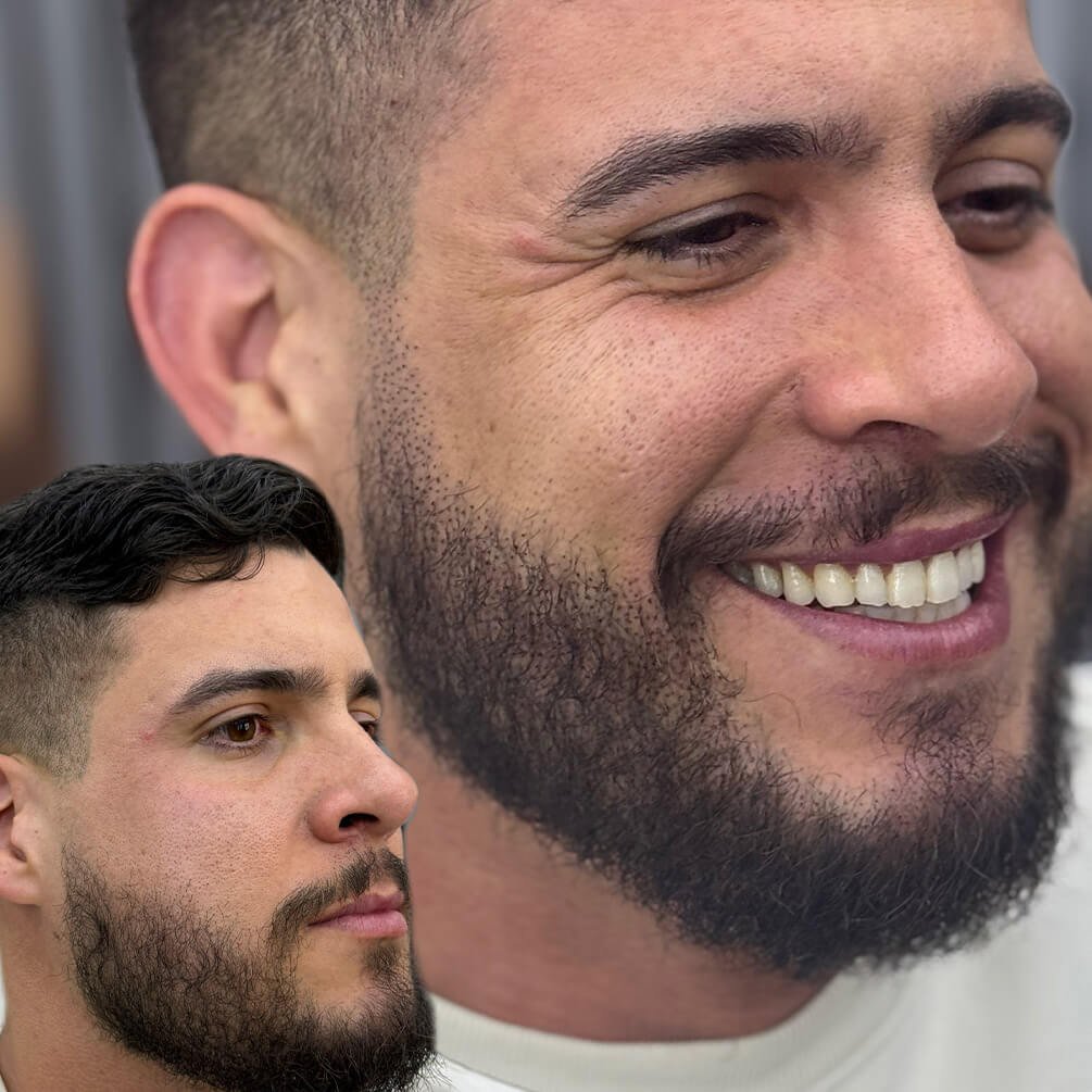 11depoimentos-micropigmentação-André