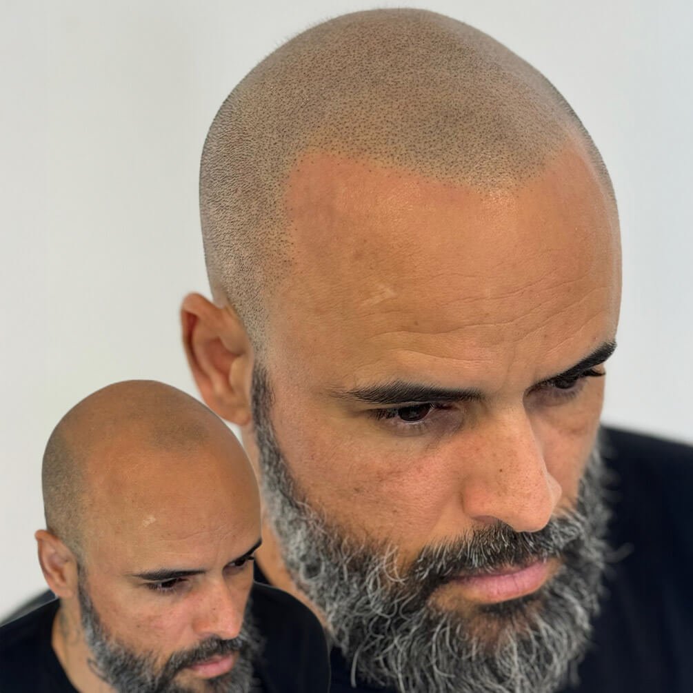 15depoimentos-micropigmentação-André