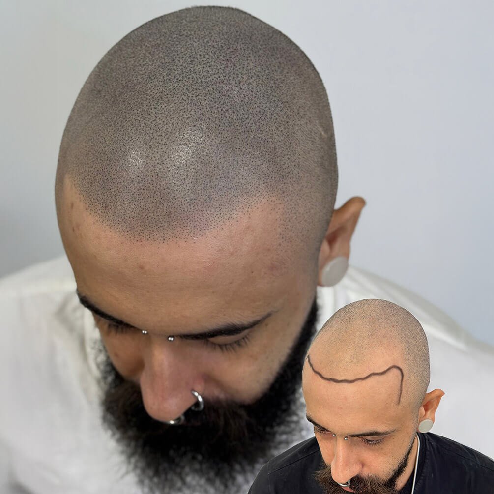 16depoimentos-micropigmentação-André