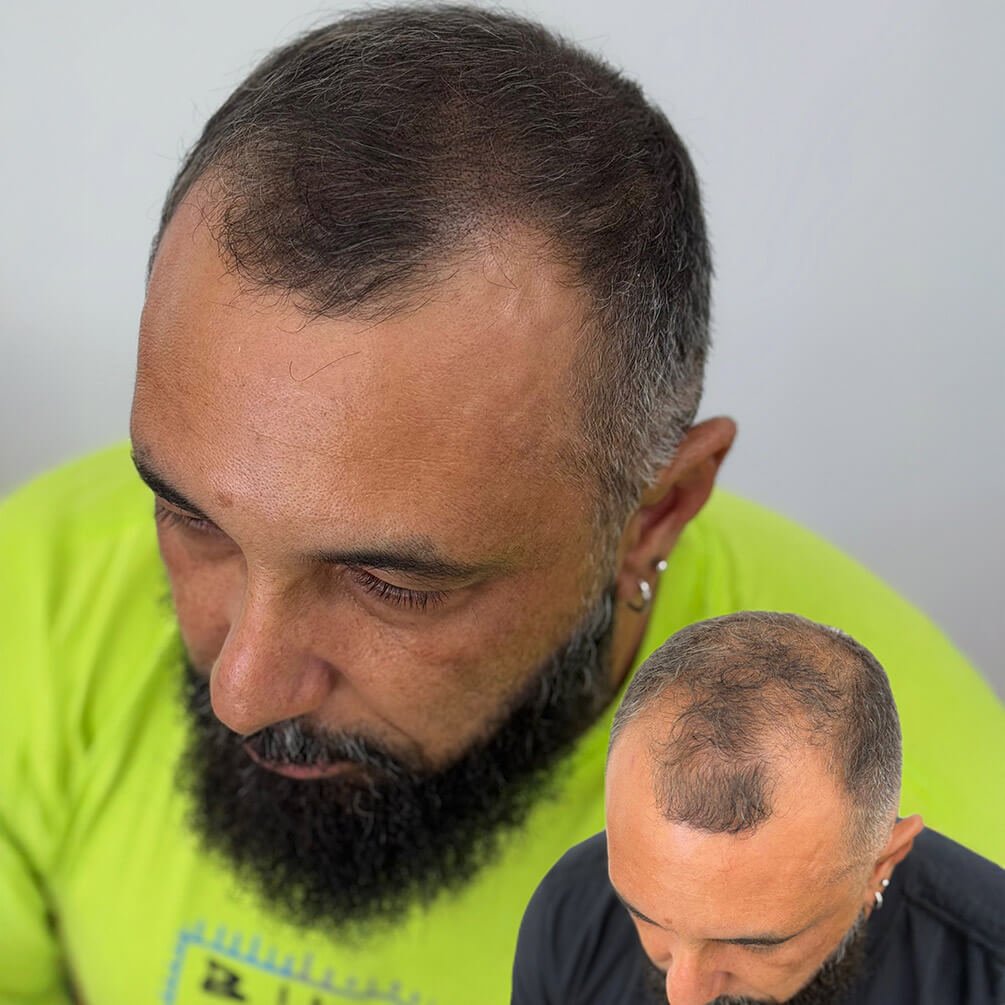 17depoimentos-micropigmentação-André