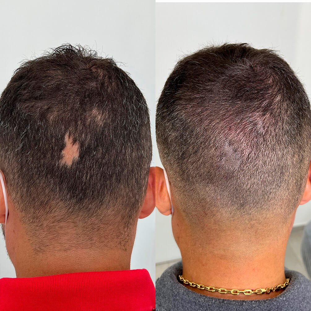 1depoimentos-micropigmentação-André