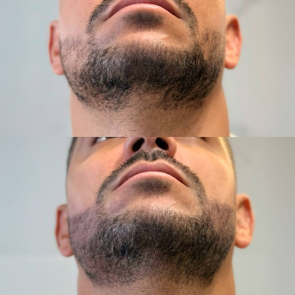 4depoimentos-micropigmentação-André