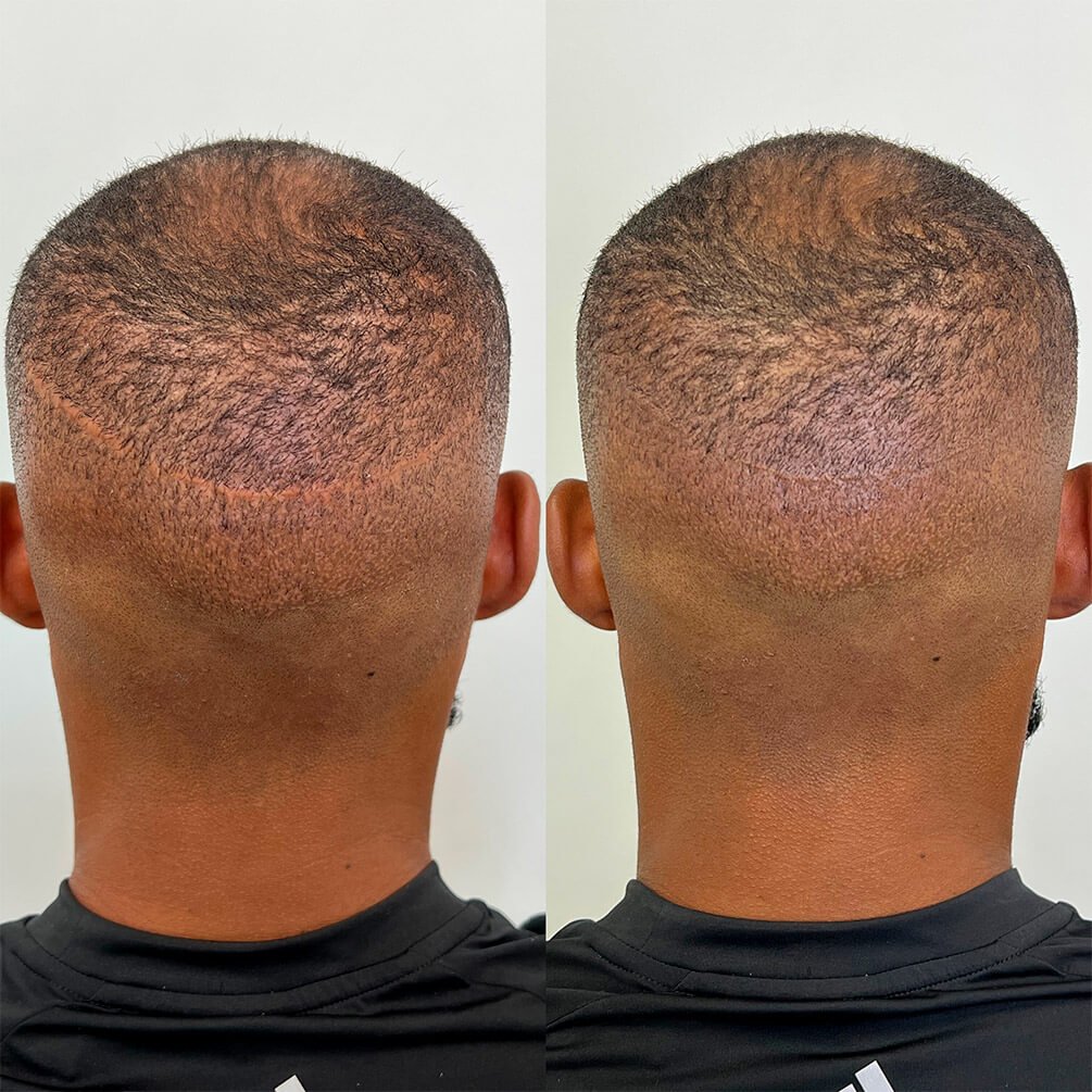 6depoimentos-micropigmentação-André