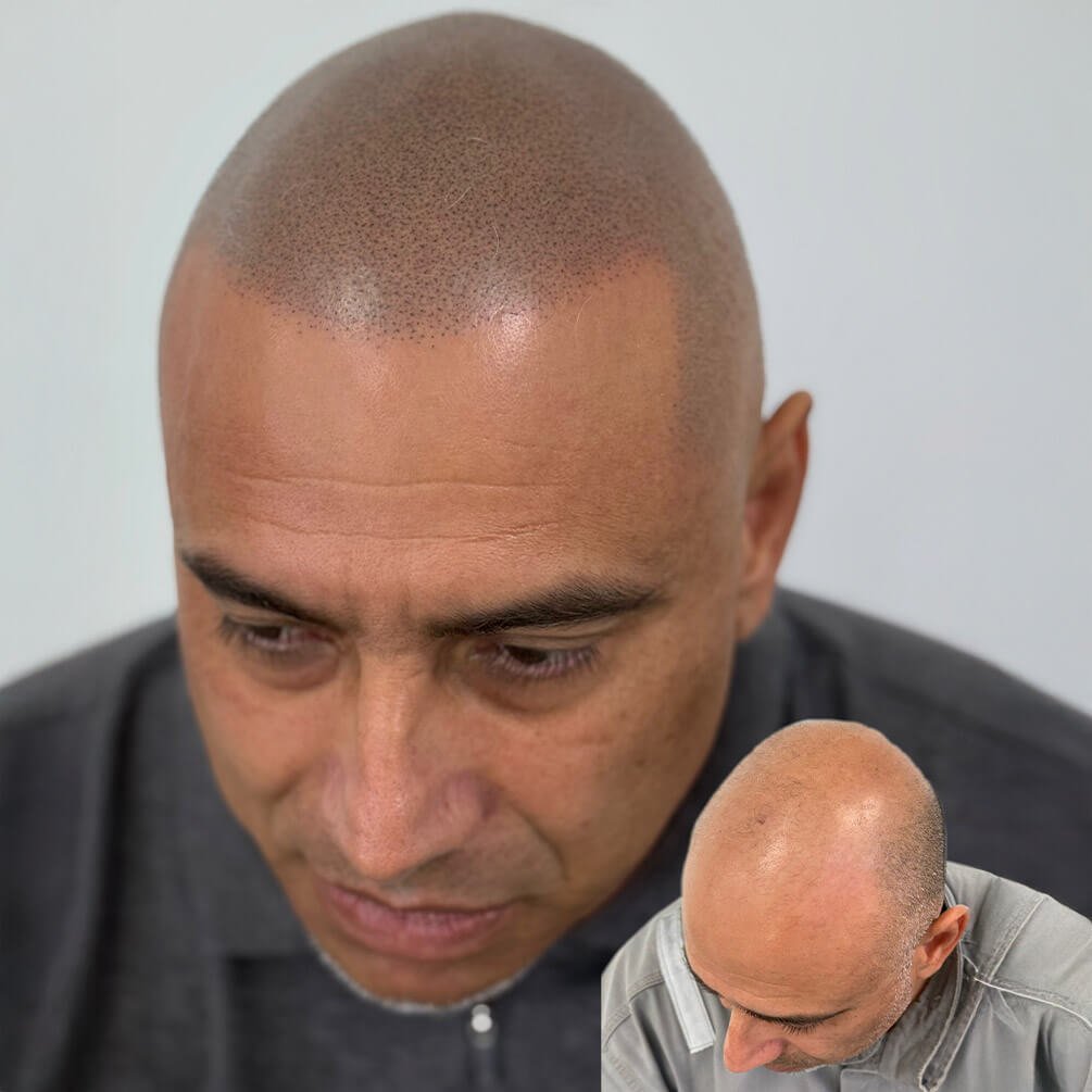 8depoimentos-micropigmentação-André