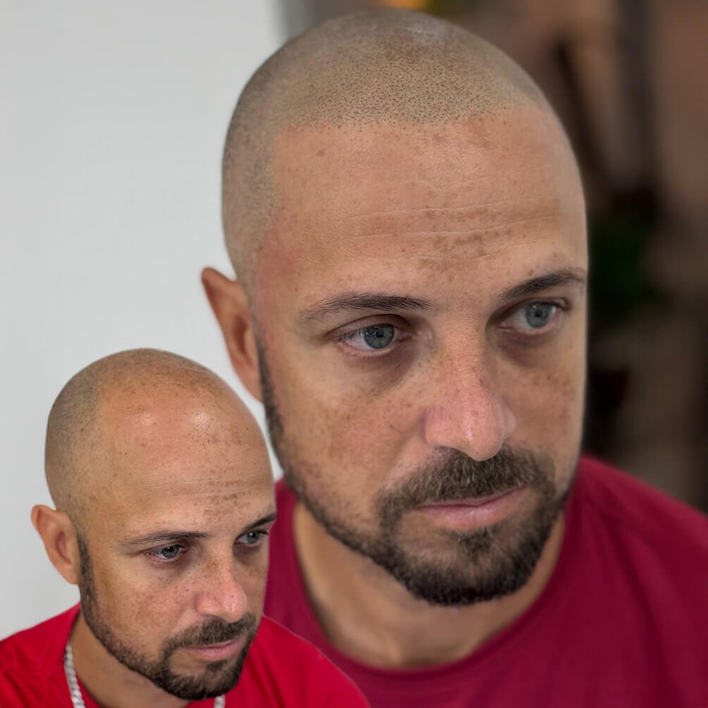 9depoimentos-micropigmentação-André